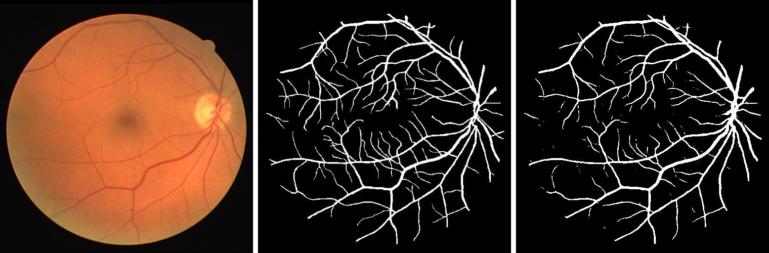 IMPROVED RETINAL VESSEL SEGMENTATION FRAMEWORK